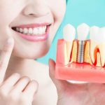 Dental Implants Procedure: What To Expect During The Treatment