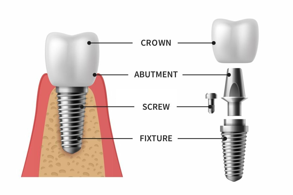 dental implants abutment