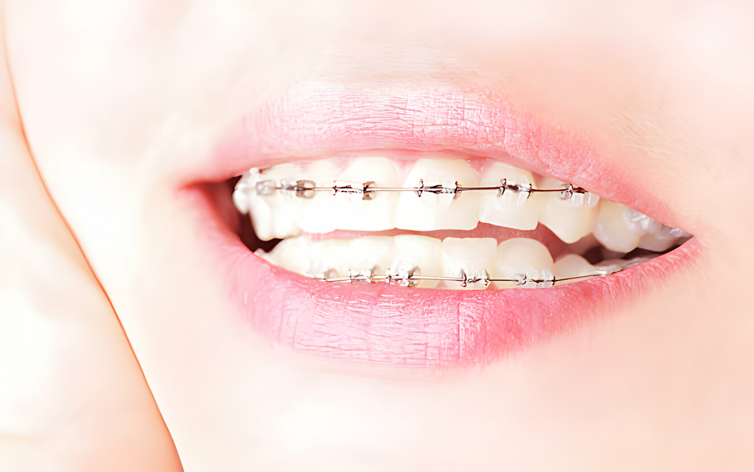 Invisalign for Teeth Vs. Traditional Braces - Know What’s Right for You!_2