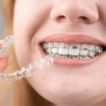 Invisalign for Teeth Vs. Traditional Braces - Know What’s Right for You!_FI