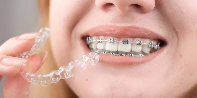 Invisalign for Teeth Vs. Traditional Braces - Know What’s Right for You!_FI
