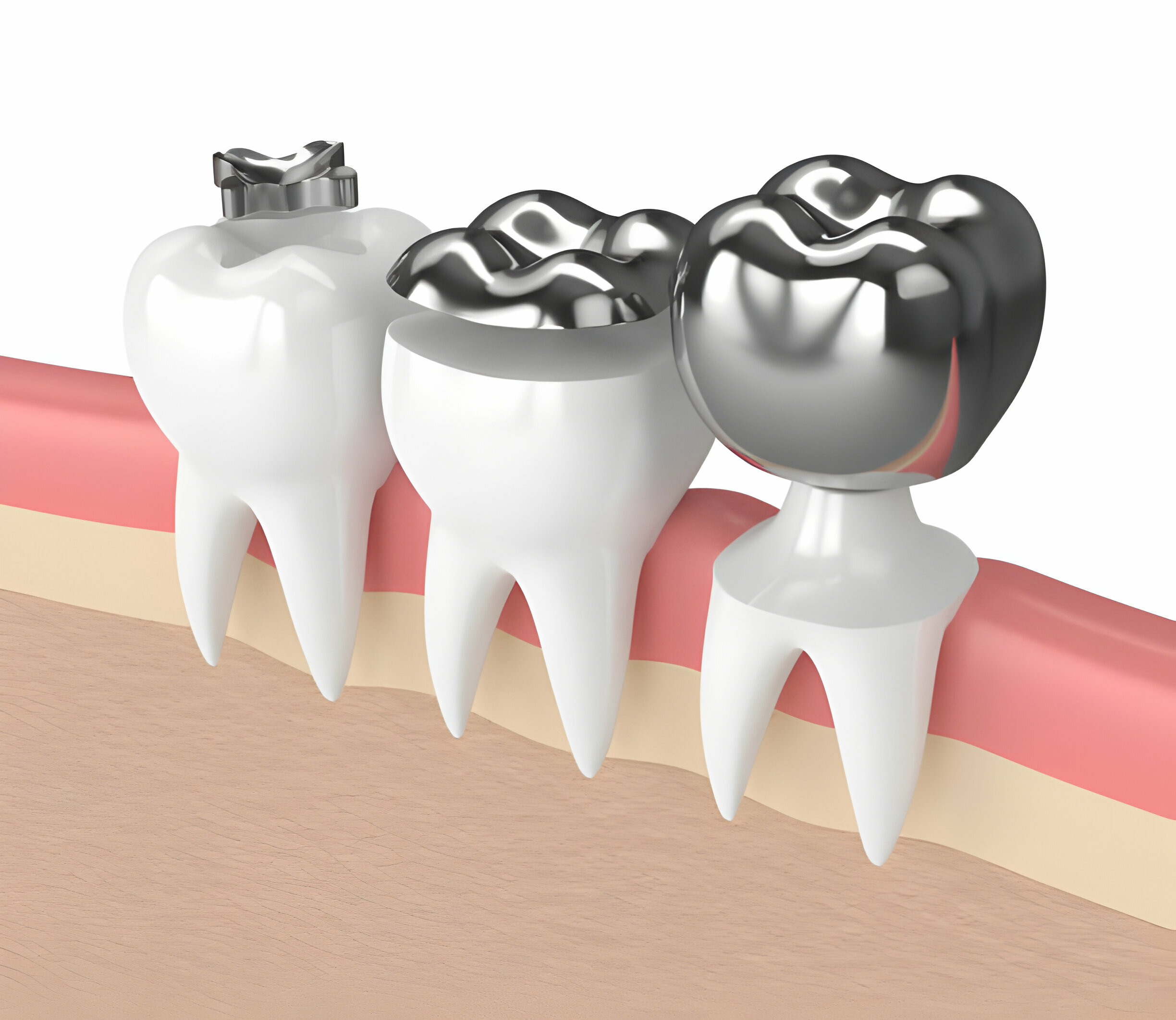 Understand 5 Conditions When You Require Dental Crown Treatment_2