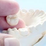 Understand 5 Conditions When You Require Dental Crown Treatment_FI
