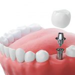 Navigating the Dental Implant Experience at Paloma Creek Dental: A Complete Guide_FI