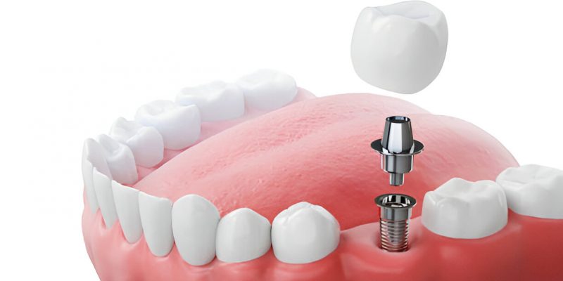 Navigating the Dental Implant Experience at Paloma Creek Dental: A Complete Guide_FI