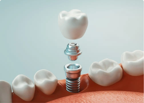 dental implants-post